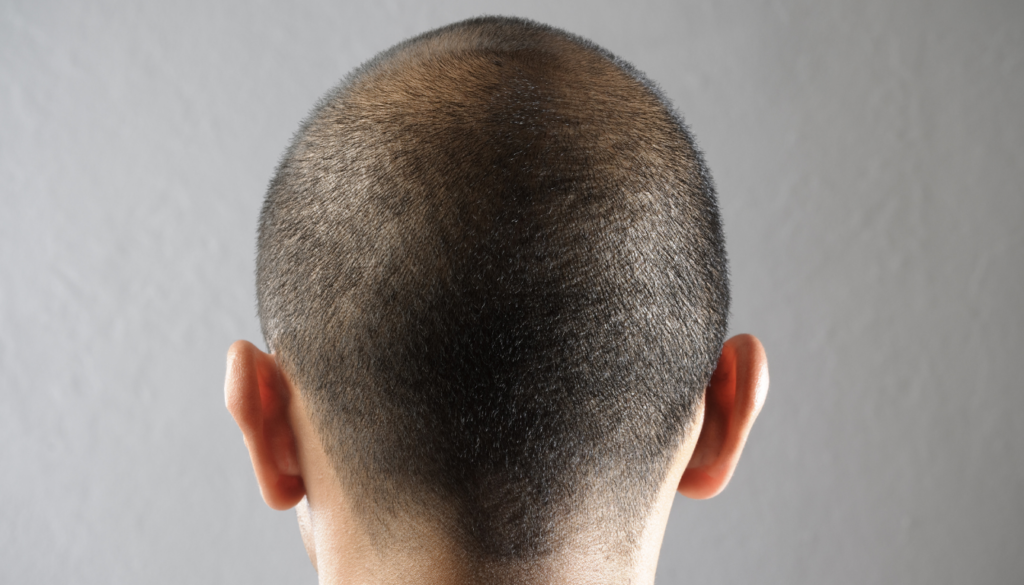 Forstå prognosen for acusticusneurinom: hvad du kan forvente - Illustration