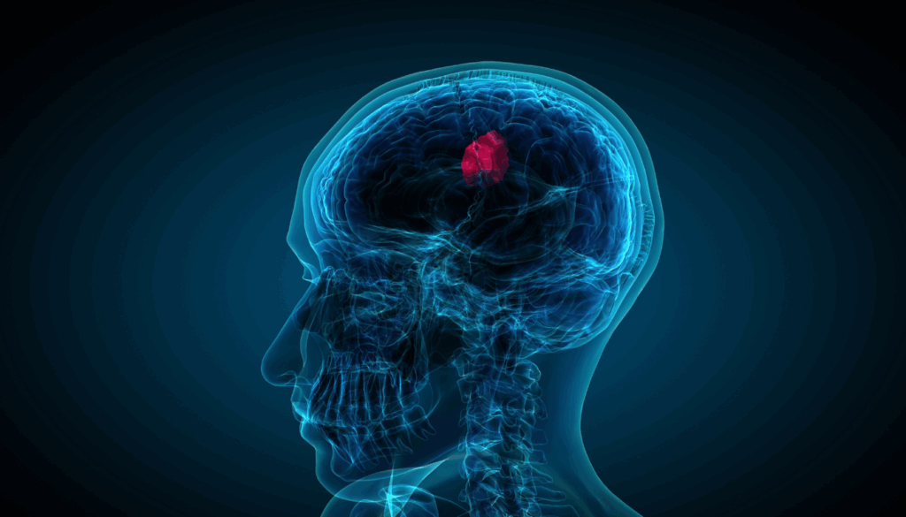 Acusticusneurinom: forstå symptomerne og behandlingsmulighederne - Illustration